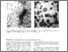 [thumbnail of hiv-related_ocular_microangiopathic_syndrome_8186.pdf]